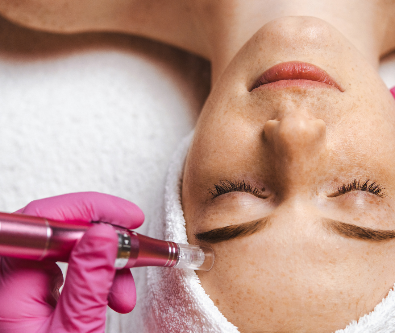 Microneedling